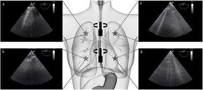 Transoesophageal Ultrasound Assessment of Lung Aeration in Patients With Acute Respiratory Distress Syndrome